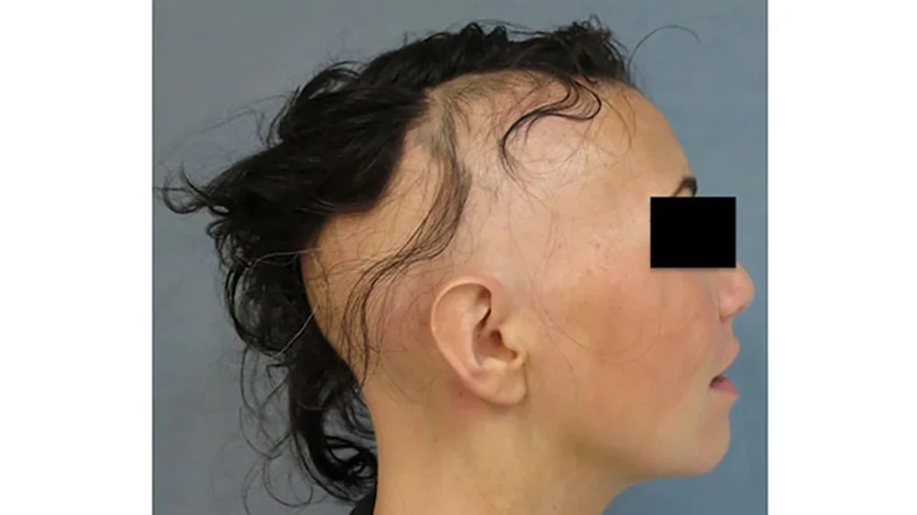 New treatment shows promise for hair-loss condition